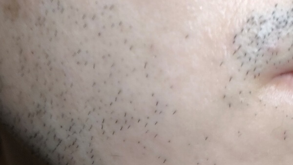 ケノンで男がヒゲを1か月脱毛した効果 ムダ毛 体毛 頬が薄くなった