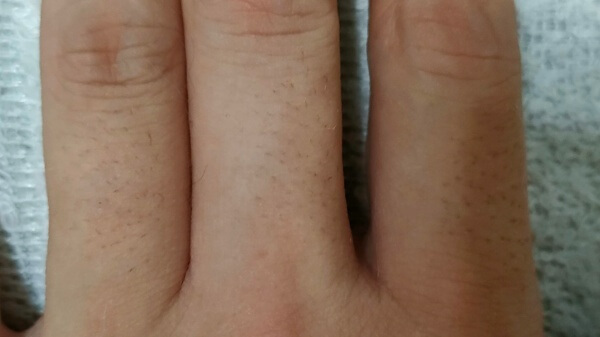 ケノンで男が手の指の毛を1か月脱毛した効果　ムダ毛　体毛　黒いブツブツ