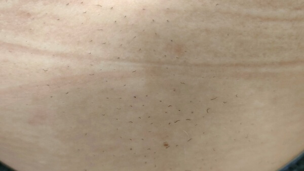 ケノンで男が腹毛を1か月脱毛した効果 ムダ毛 体毛 脱毛器 へそ毛 ギャランドゥ