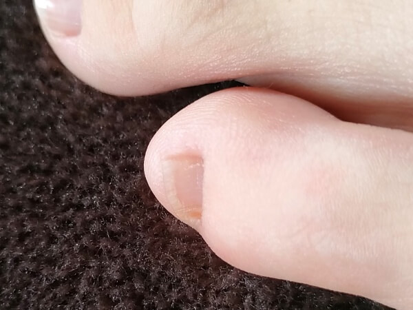足の爪剥がれ　絆創膏で固定　綺麗に生える？